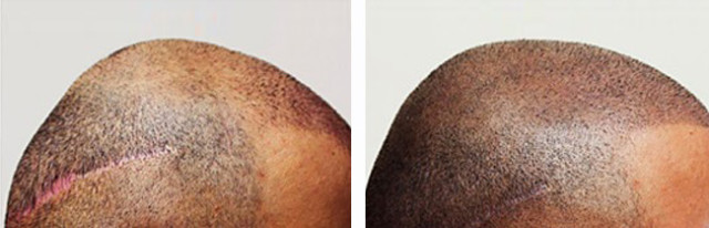 Medicine-of-Cosmetics-Scalp-Micro-Pigmentation-Adelaide-Hair-Loss-Balding-Cure-16